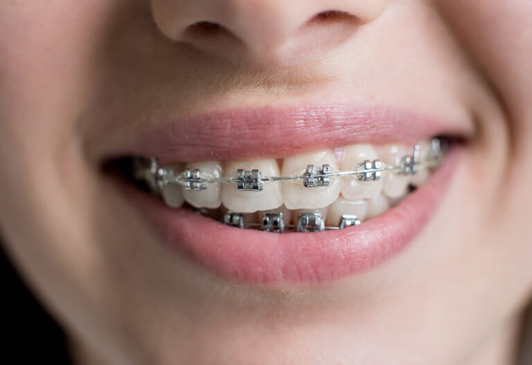 brackets