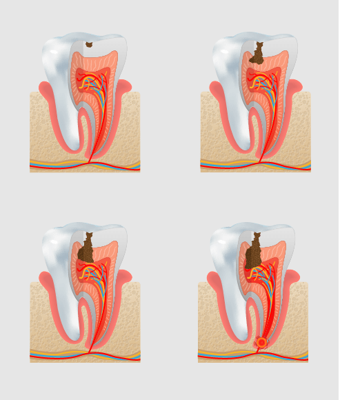 fases de la caries dental