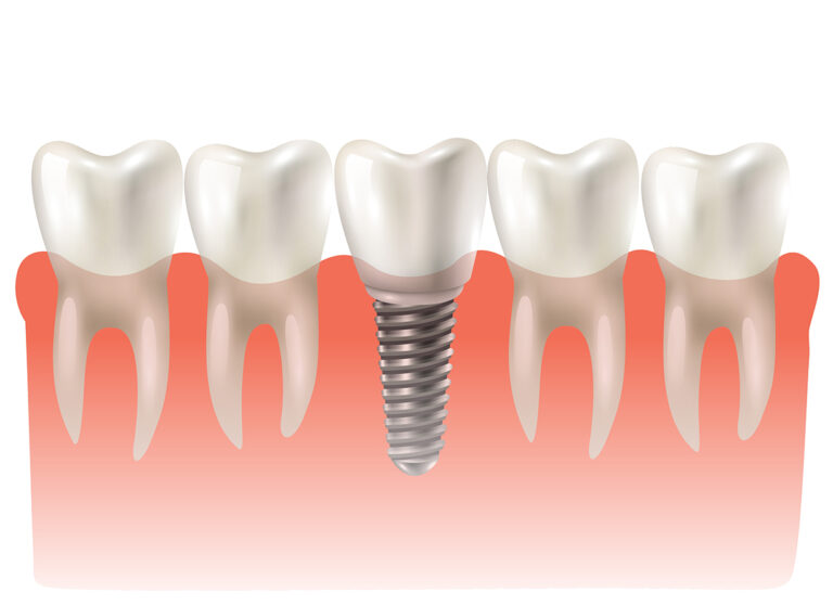 implante dental huesca